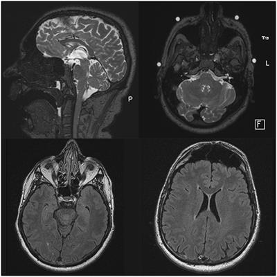 Case Report: Deep brain stimulation improves tremor in FGF-14 associated spinocerebellar ataxia